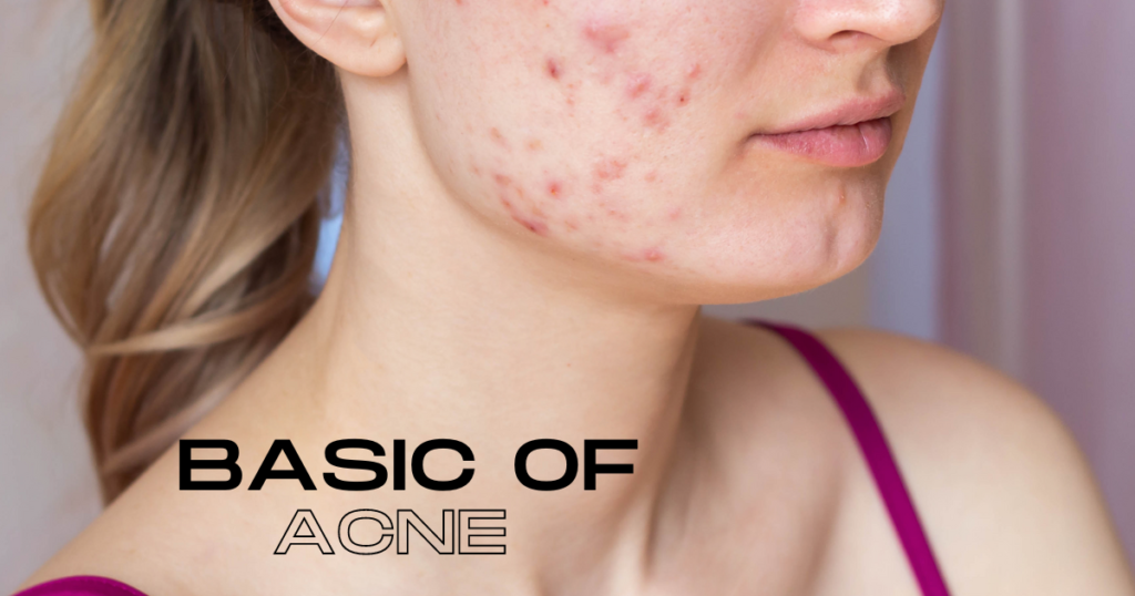 Basic of Acne